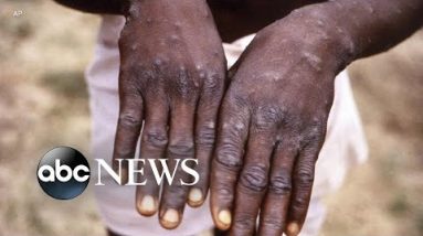 Monkeypox outbreak a global successfully being emergency: WHO