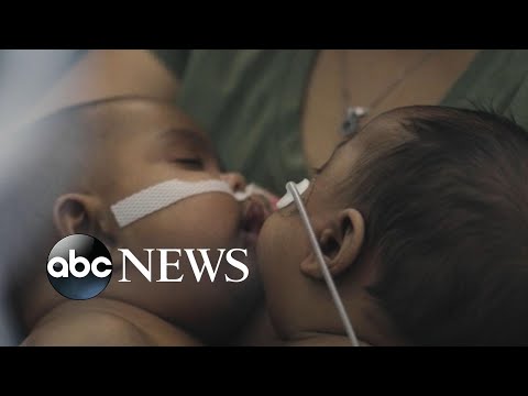 Historic surgery to separate twins