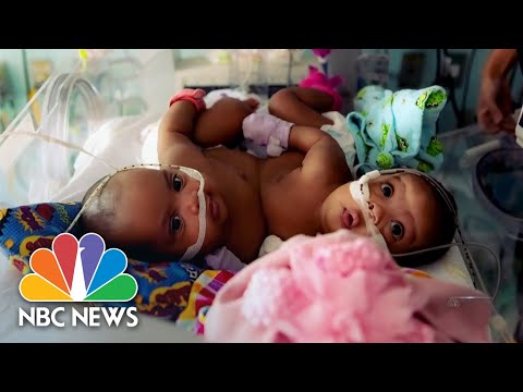 Conjoined twins separated in miracle map