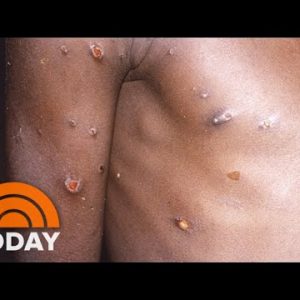 Neatly being Officers Investigate New Monkeypox Case In Florida