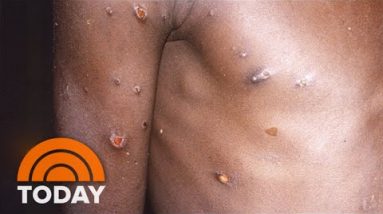Neatly being Officers Investigate New Monkeypox Case In Florida
