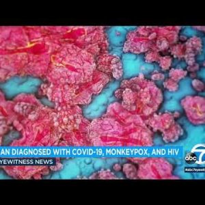 Man gets monkeypox, COVID-19 and HIV on the an analogous time | ABC7