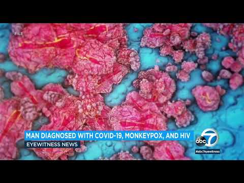 Man gets monkeypox, COVID-19 and HIV on the an analogous time | ABC7