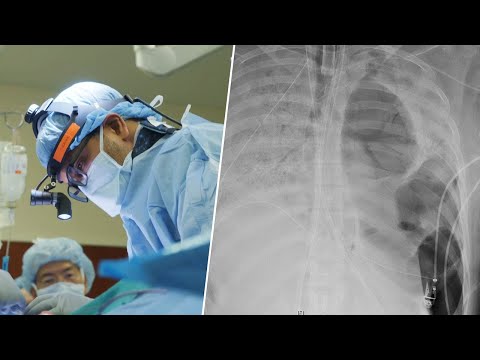 Young Girl’s Lifestyles Saved by Double Lung Transplant | Coronavirus Files for June 11, 2020