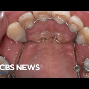 Lawsuit claims dental tool damaged sufferers’ teeth
