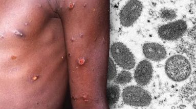 Rare Monkeypox Virus Be conscious in Several Countries