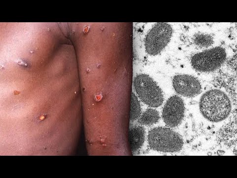 Rare Monkeypox Virus Be conscious in Several Countries